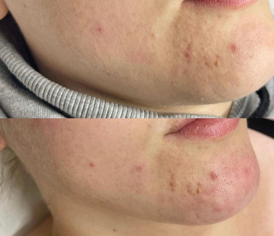Aesthetic Facials Treatments - EMS Sculpt (30 Mins)