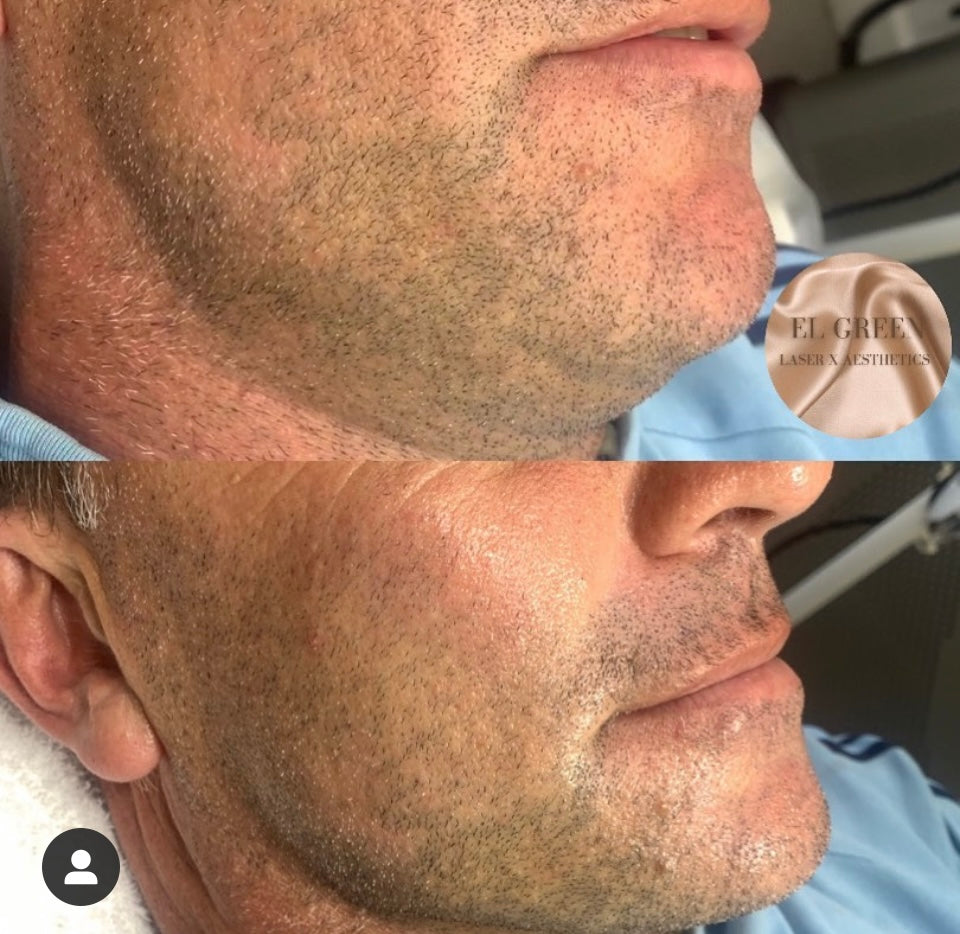 Aesthetic Facials Treatments - EMS Sculpt (30 Mins)